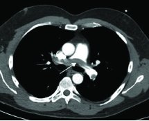 Lung Scan